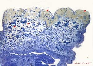 F,8m. | lipid malabsorption - large lipid droplets in enterocytes … semithin section